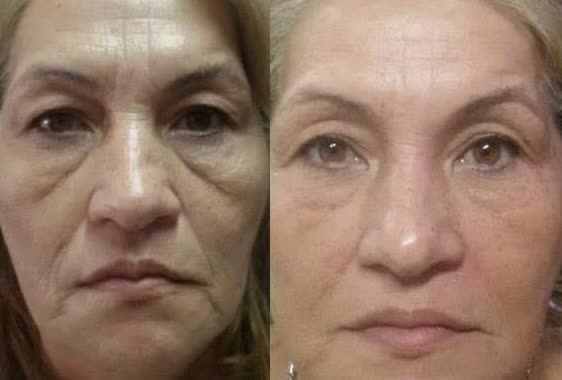 خرید کرم ضد چین و چروک صورت گاتیو اصل _ بیوممتیک