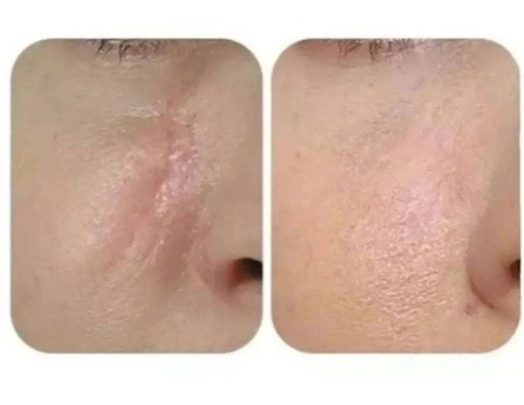 خرید کرم رفع ترکهای پوستی گاتیو (استرچ مارک)اصل_ بیوممتیک