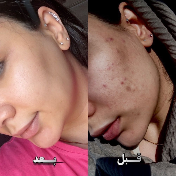 خرید کرم ژل آنتی آکنه (ضدجوش و ضد لک) گاتیو اصل_ بیوممتیک